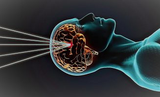 Стереотаксическая радиохирургия